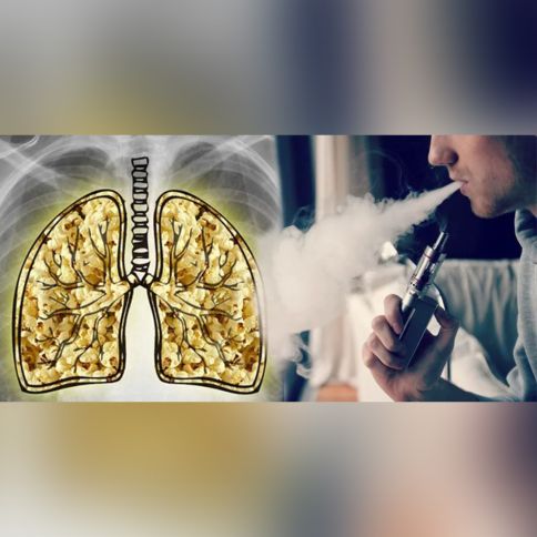 Elektron siqaret istifadəsi "Popkorn" xəstəliyinə səbəb olur